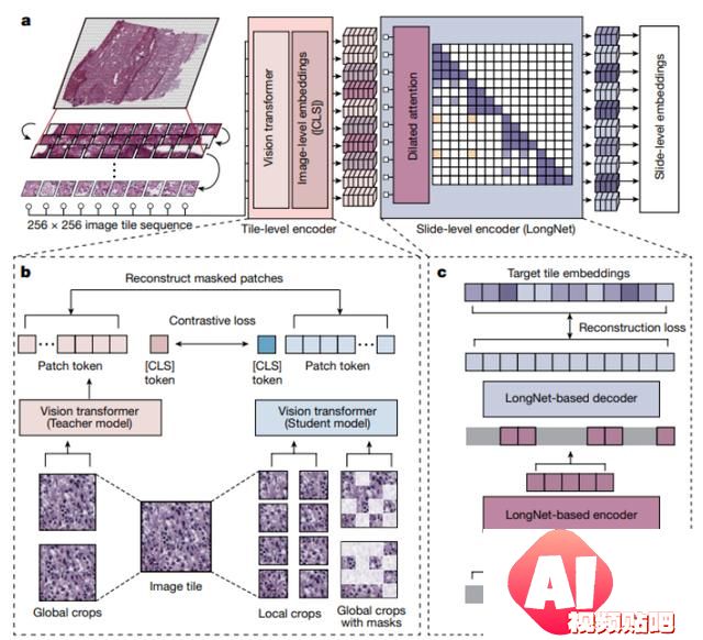 AI病理学大模型革新癌症诊断，科学家揭秘技术突破