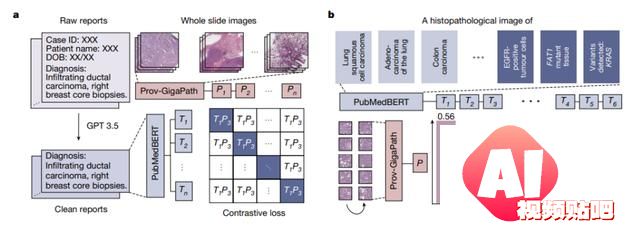 AI病理学大模型革新癌症诊断，科学家揭秘技术突破